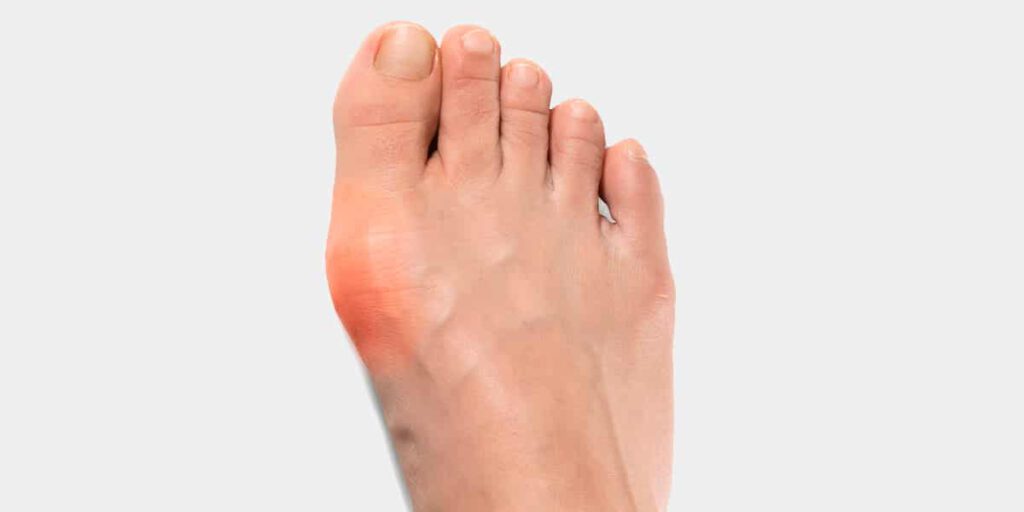 Hallux Valgus