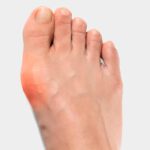 Hallux Valgus